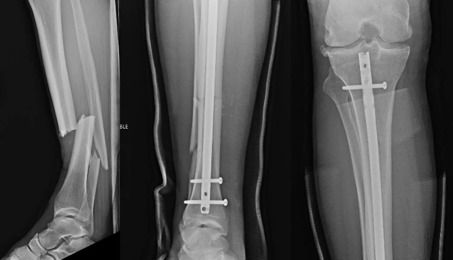 Трещина голени. Винтообразный перелом малоберцовой кости. Винтообразный перелом большеберцовой кости. Малоберцовая кость рентген. Винтообразный перелом рентген.