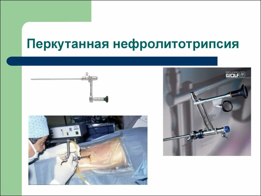 Эндоскопическое удаление почки