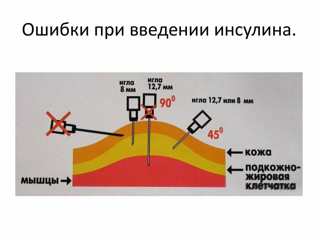 Инъекция инсулина алгоритм. Подкожная инъекция инсулина алгоритм. Подкожное Введение инсулина алгоритм. Техника инъекций инсулина. Области введения инсулина подкожно.