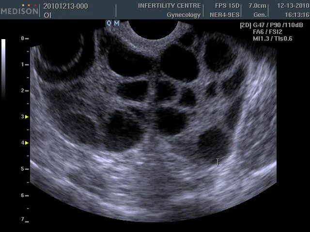Синдром гиперстимуляции яичников УЗИ. УЗИ мультифолликулярных яичников. Болят яичники стимуляция