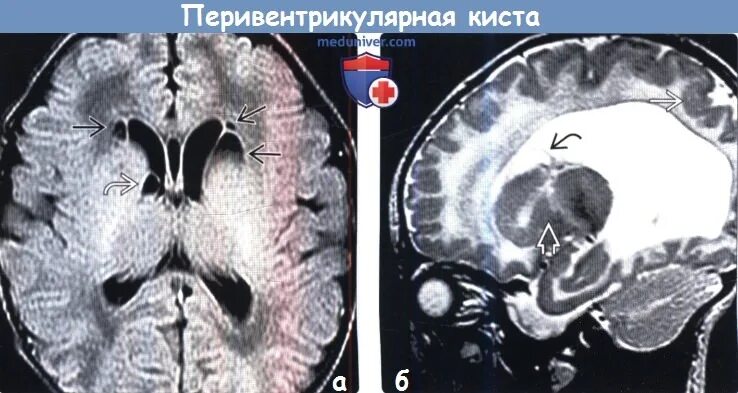 Киста желудочка головного мозга. Перивентрикулярная киста мрт. Субэпендимальная киста головного мозга мрт. Перивентрикулярная лейкомаляция кт. Арахноидальная киста желудочка.