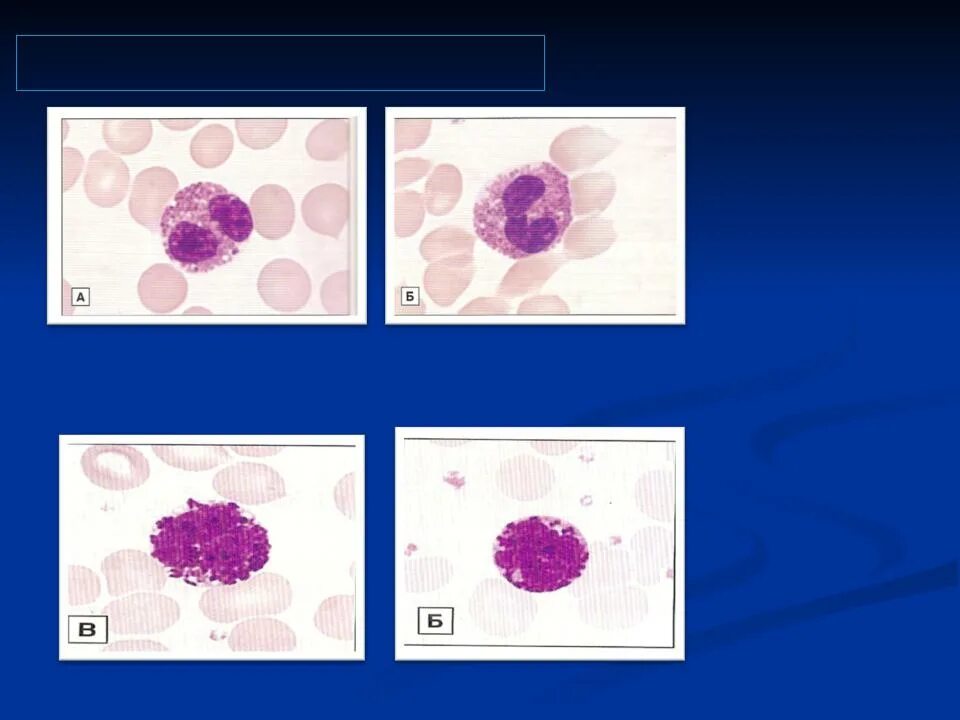Базофилы в крови 1. Базофилы и операции. Повешение базофилов у детей. Эозинофилы и базофилы красивая схема. Базофилы в лейкемии.