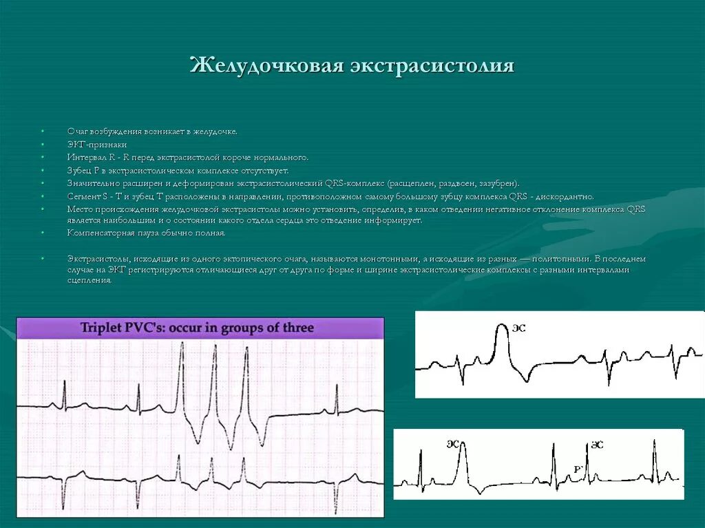 Желудочкова яаритмия ЭУГ. Аритмия и экстрасистолия на ЭКГ. Желудочковая экстрасистолаэкг. Экстрасистола желудочков на ЭКГ. Экстрасистолы ощущения
