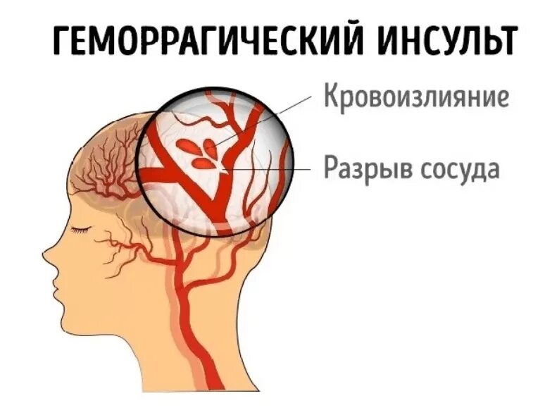 Головной микроинсульт. Геморрагический инсульт. Геморрагический инсульт кровоизлияние. Геморрагический инсульт разрыв сосуда.