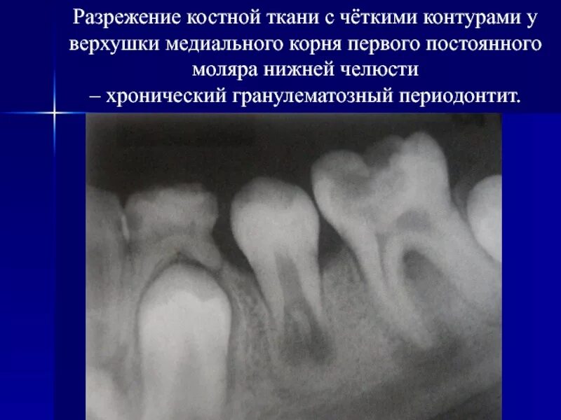 Непрерывно корень. Хронический гранулематозный периодонтит периодонтит. Гранулематозный периодонтит рентген зуба. Периодонтит фиброзный гранулематозный гранулирующий. Остеопороз нижней челюсти рентген.