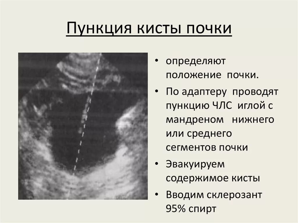 Киста размеры для операции. Кисты чашечно лоханочной системы. Чрескожная пункция кисты почки. Чрескожная игнипунктура кисты почек. Пункция почки под контролем УЗИ.