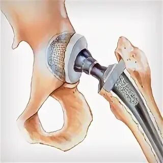 Цементный эндопротез тазобедренного сустава. Эндопротезирование тазобедренного сустава DEPUY. Перелом шейки бедра операция эндопротез. Эндопротез тазобедренного сустава Trident-Accolade. Операция шейки бедра стоимость
