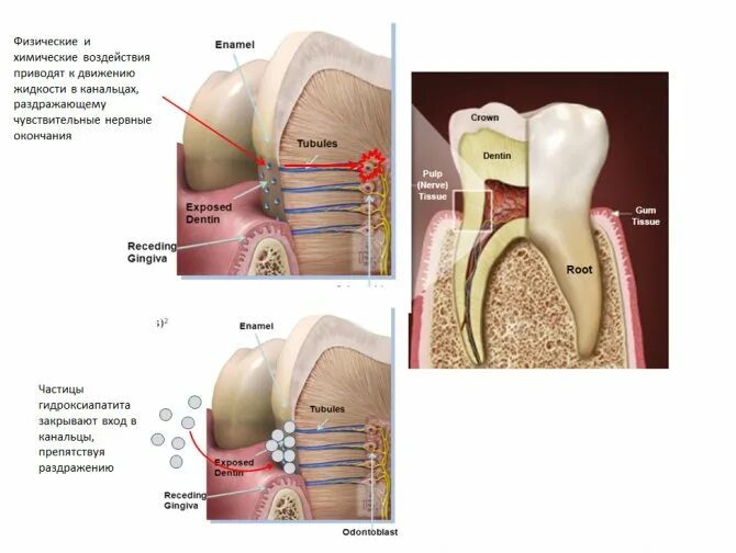 Почему чувствительность зуба. Гиперчувствительность зубов дентинные канальцы. Повышенное чувствительность зубов. Чувствительность дентина.