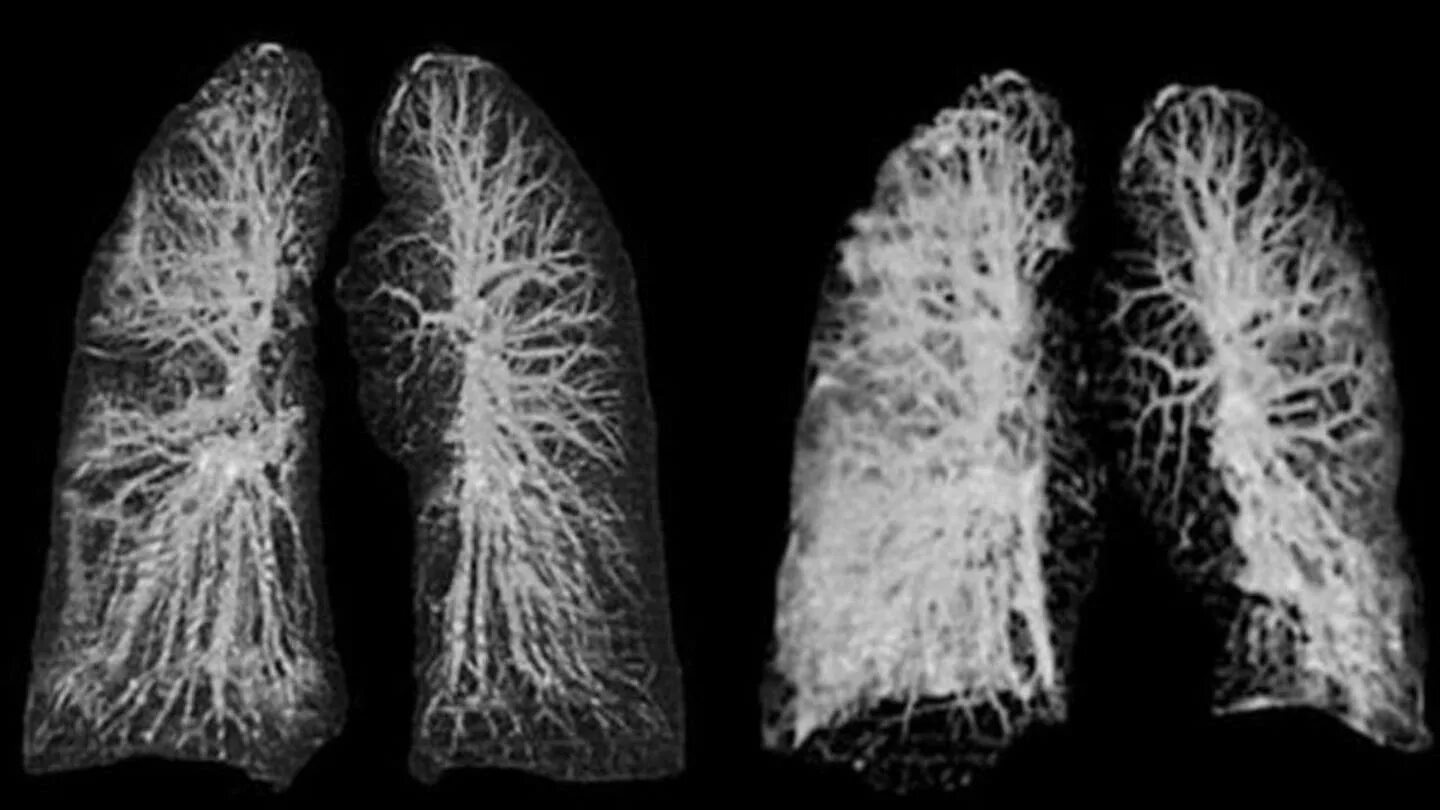 Фиброз легких после ковид