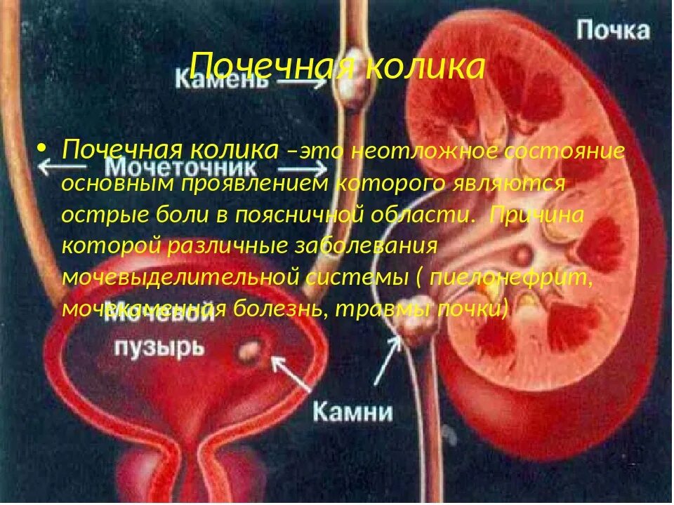 Заболевание почечная колика. Почечно-каменная болезнь почечная колика. Мочекаменная болезнь почечная колика. Заболевание, основным проявлением которого является почечная колика.