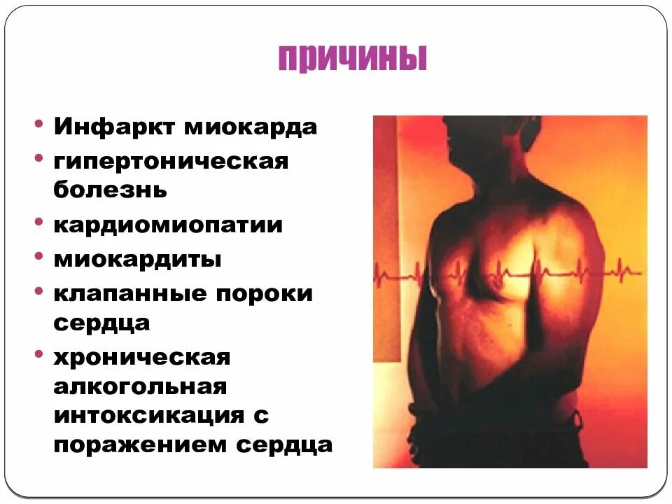 Основная приятна инфаркта миокарда. Причины развития инфаркта миокарда. Инфаркт миокарда причины возникновения. Перечислите причины инфарктов. Факторы риска возникновения инфаркта.