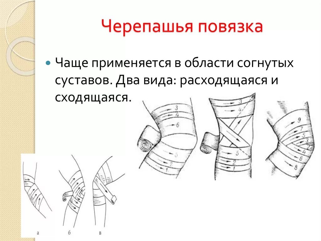 Черепашья повязка алгоритм. Алгоритм наложения черепашьей повязки. черепашья повязка сходящаяся и расходящаяся. черепашья повязка на коленный сустав показания.