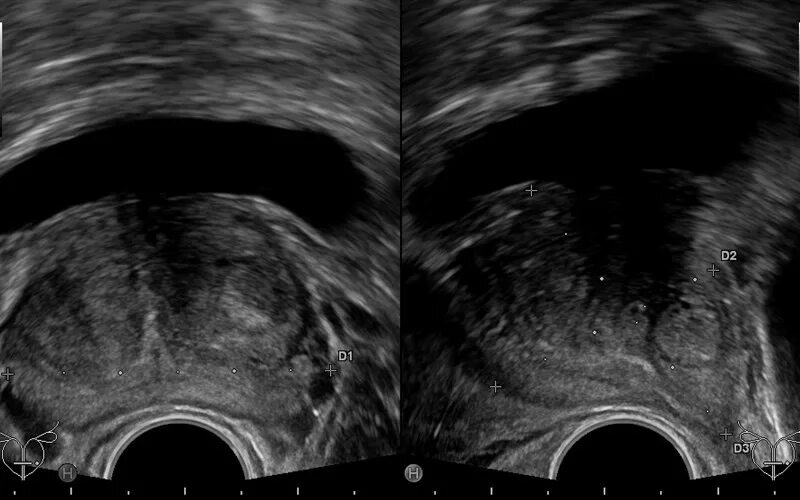 Дгпж узи. Трансректальное УЗИ предстательной железы. Карцинома предстательной железы УЗИ. Сонограмма предстательной железы. Аденома предстательной железы на УЗИ.