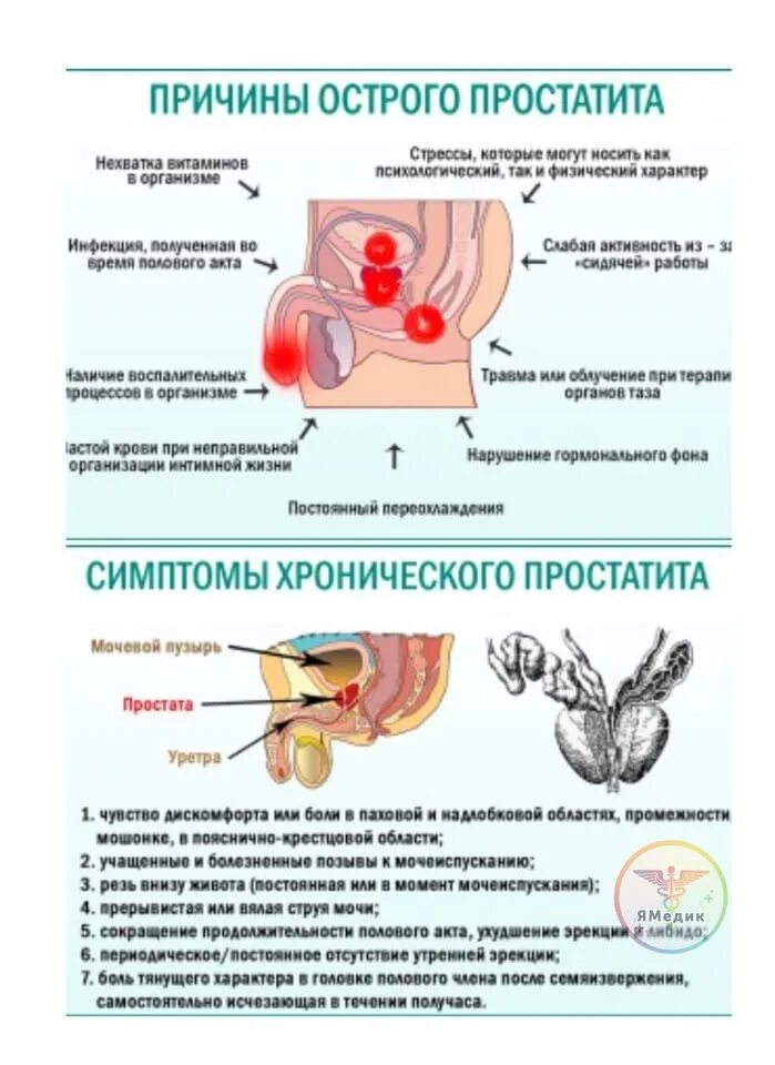 Простатиты симптомы ощущения и лечение