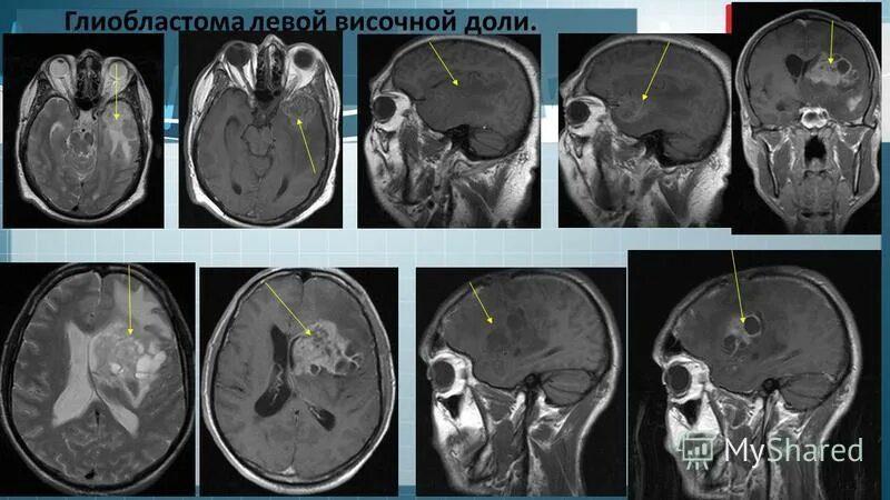 операция височной доли. опухоль головного мозга височной доли снимок кт. хирургия при эпилепсии. эпилепсия при остеоме левой височной доле. опухоль височной доли мрт.