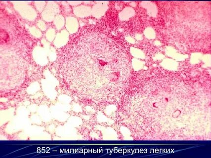 Милиарный туберкулез легких описание