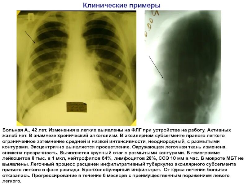 Инфильтративный туберкулез в фазе распада рентген. Изменения при туберкулёзе на ФЛГ. Затемнение в левом легком