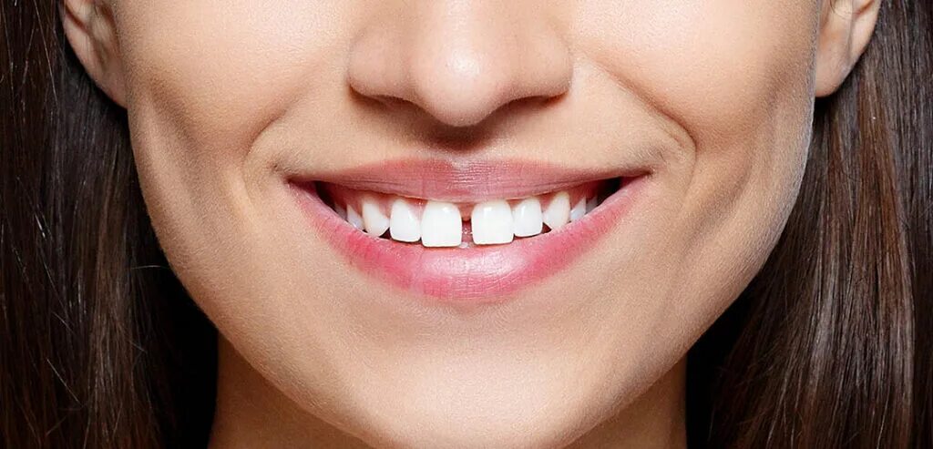 Эмма стоун исправила прикус. Дакота джонсон щербинка между зубами. Виниры у звезд. Как убрать щербинку между передними зубами. Как убрать щербинку между передними зубами.