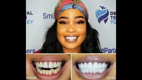 porcelain veneers, porcelain crowns, cosmetic dentist, veneers experience, teeth...