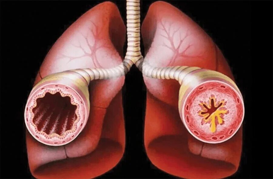 Почему ба. Бронхиальная астма обструкция. Трахеит, бронхит бронхиальная астма. Бронхиальная астма это хроническое заболевание.