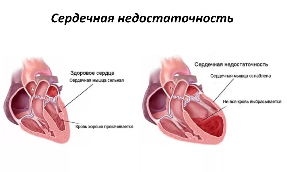 Острая хроническая недостаточность. Острая и хроническая сердечная недостаточность. Сердце при острой сердечной недостаточности. Сесердечная недостаточность это. Сердечная недостаточность обусловлена