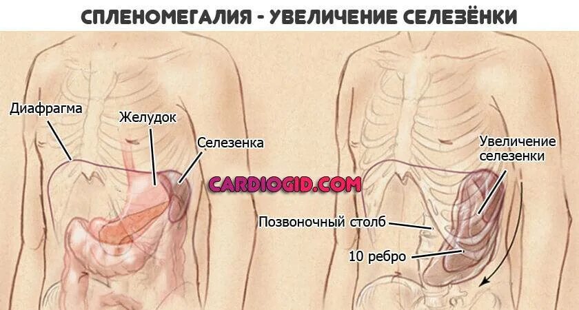 Увеличена селезенка у мужчины