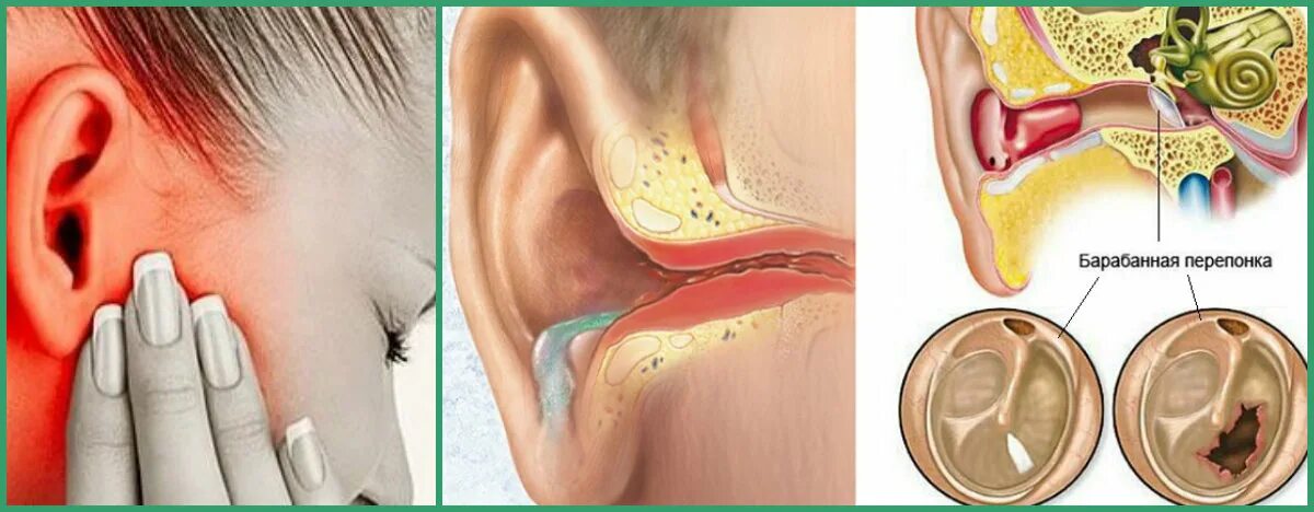 Почему трещит в ухе. Острый наружный средний отит. Отомикоз серная пробка.