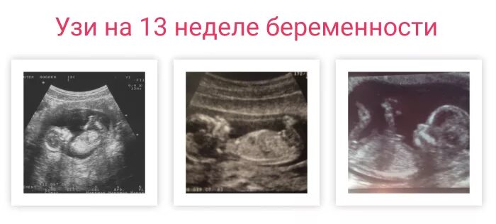 Как выглядит ребенок на УЗИ В 13 недель. УЗИ на 13 неделе беременности скрининг. УЗИ 13 недель беременности скрининговое. Узи ребенка на 13 неделе