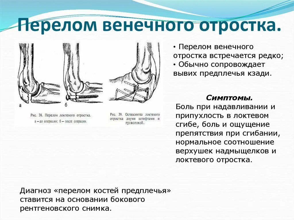 Перелом венечного отростка локтевой кости. Перелом венечного отростка локтевая кость. Перелом локтевого отростка рентген. Перелом локтевого отростка локтевой кости рентген.