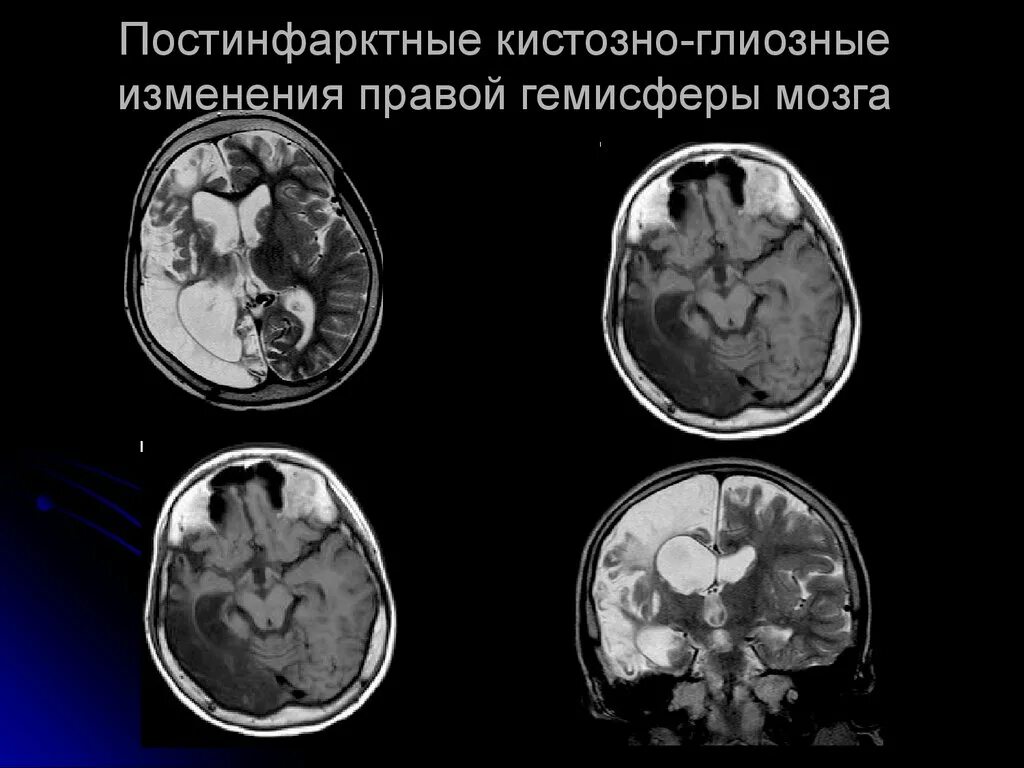 Кистозно-атрофические изменения головного мозга мрт. Кистозно-глиозная трансформация головного мозга на кт. Кистозно-глиозные изменения головного. Глиозные изменения головного мозга на кт. Глиозные изменения лобной доли