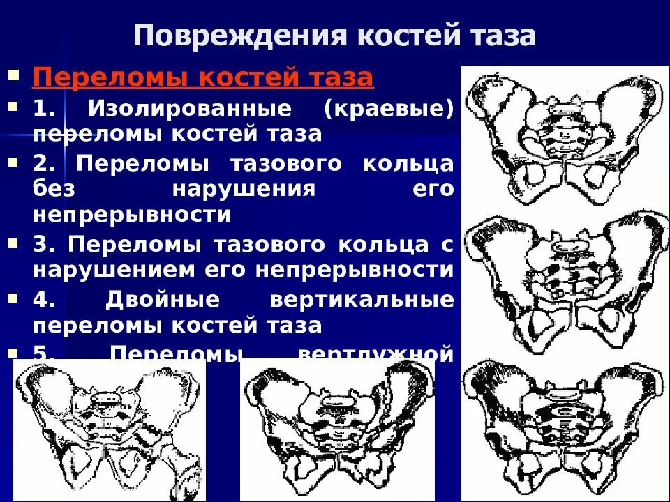 Разрыв кости. Повреждение костей таза. Повреждения тазового кольца. Переломы с нарушением непрерывности тазового кольца.