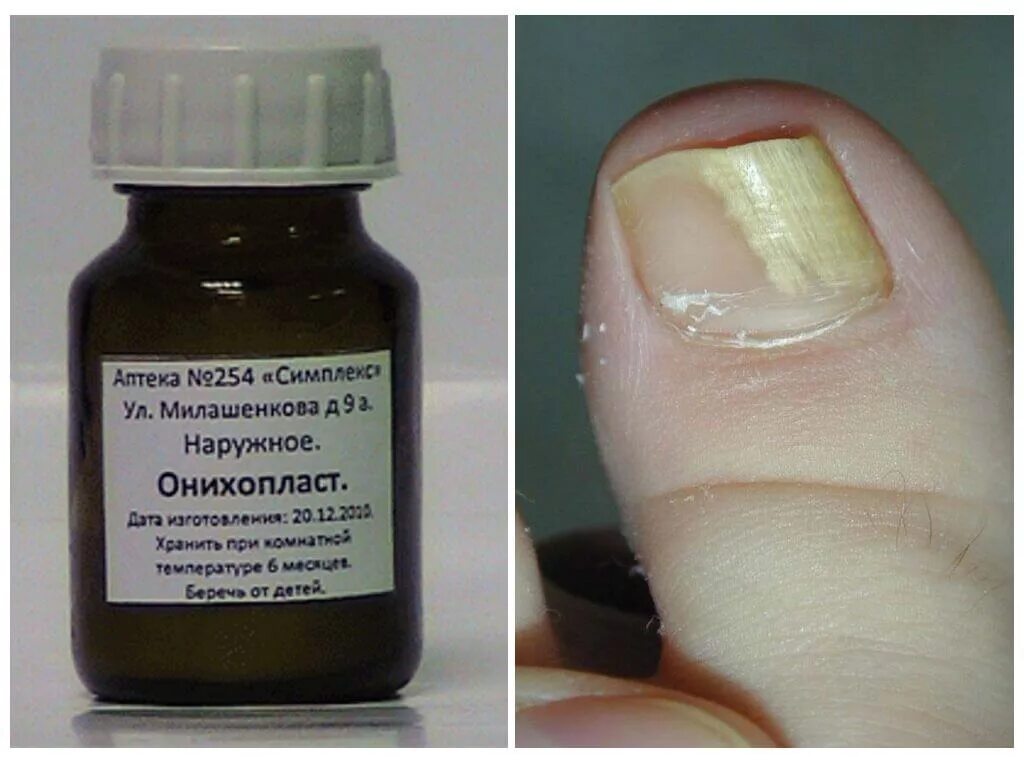 ПСЕВДОМОНИЯ- одно из заболеваний ногтей. Вызывается бактерией синегнойной палочк