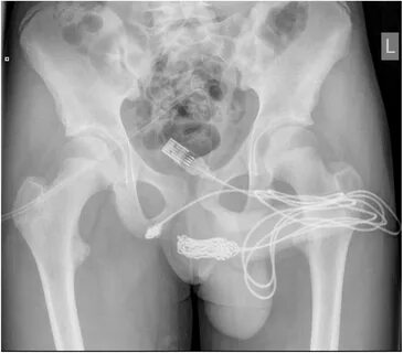 Foto rontgen yang dicantumkan dalam makalah "Urethral Self-Insertion O...