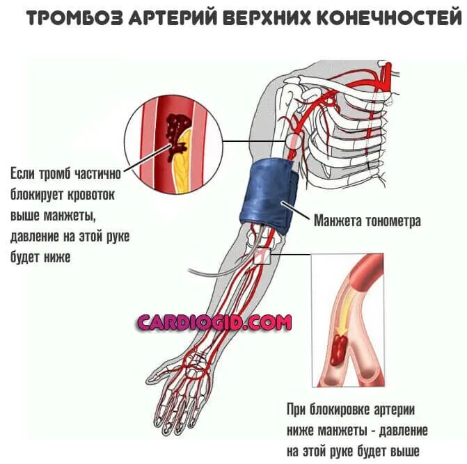 Тромбоэмболия сосудов верхних конечностей. Тромбоз артерии верхней конечности клиника. Подключичная артерия верхней конечности. Тромбоэмболия лучевой артерии. Подключичный тромбоз