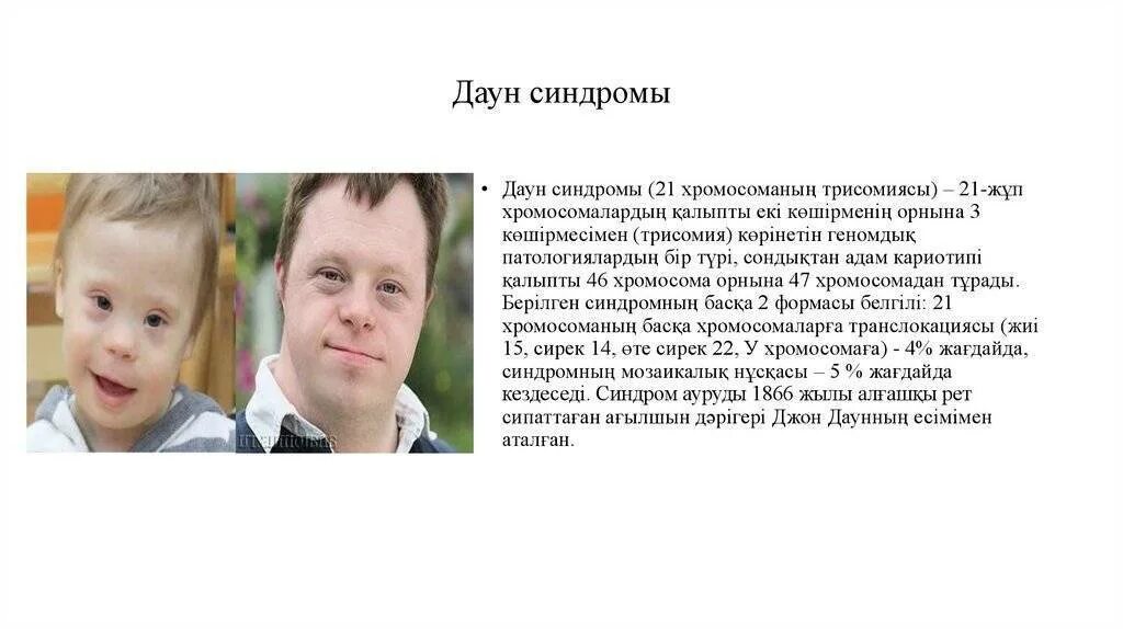 Синдром дауна интеллект. Синдром дауна. дети с болезнью дауна. синдром дауна у детей презентация.