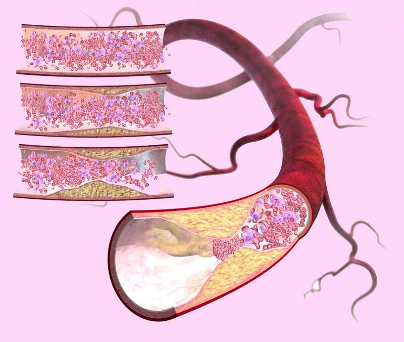 Распад сосудов. Сосуды при атеросклерозе.
