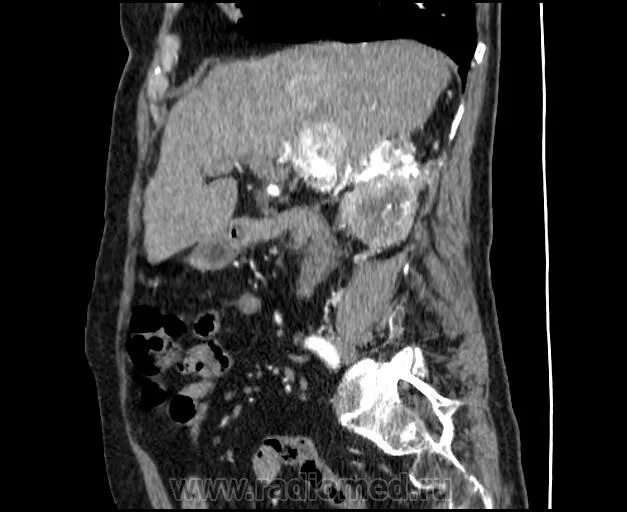 Тромбоз воротной вены на кт. Опухолевый тромбоз почечной вены кт. Тромбоз почек