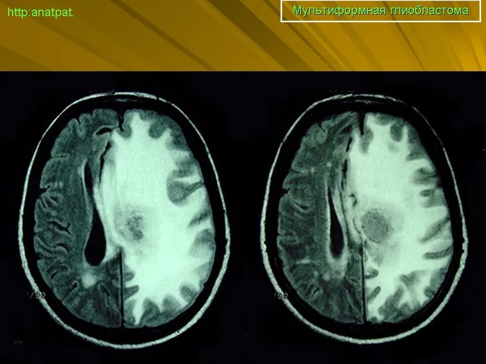 Глиобластома мозга симптомы. Мультиформная глиобластома головного мозга. Мультиформная глиобластома мрт. Мультиформная глиобластома на мосту.