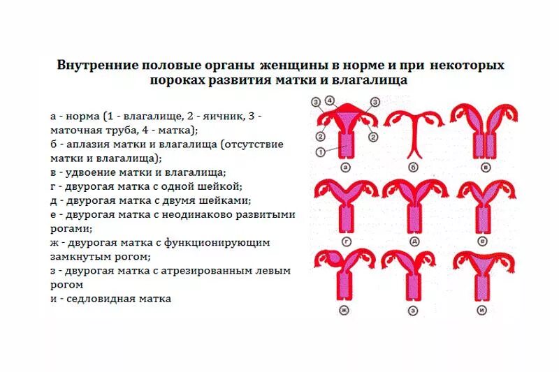 Матка 35 мм. Врожденные аномалии развития матки. Дефекты развития половых органов. Аномалии развития женских органов. Правильная форма матки.