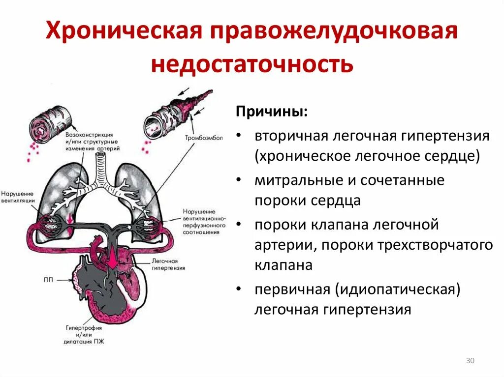 При сердечной недостаточности наблюдается. Причины острой правожелудочковой сердечной недостаточности. Патогенез правожелудочковой сердечной недостаточности. Патогенез острой правожелудочковой недостаточности схема. Хроническая левожелудочковая сердечная недостаточность патогенез.