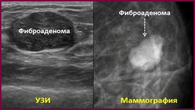 Фиброаденомы молочных желез что такое симптомы. Фибролипома маммография. периканаликулярная фиброаденома молочной железы узи. фиброаденома молочной железы маммография. фиброаденома доброкачественная опухоль молочной железы узи.