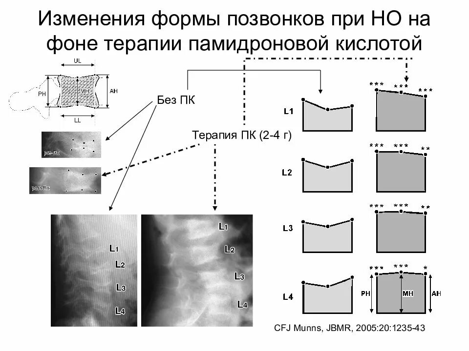 Изменение формы позвонка. Измененная форма позвоночника. Кубическая форма позвонков. Двояковогнутая форма позвонков. Изменение формы позвоночника