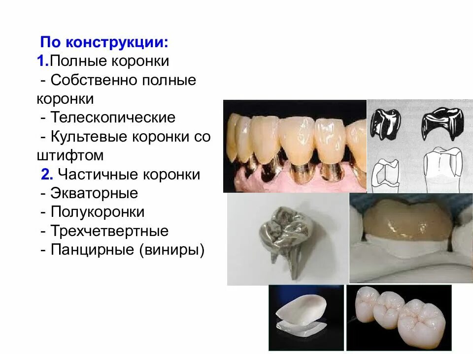 Почему ставят коронки. Экваторные коронки неметаллические. Классификация металлокерамических коронок. Экваторная коронка полукоронка. Экваторные коронки препарирование.