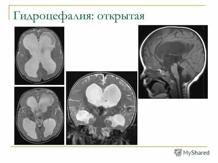 Признаки наружной гидроцефалии у взрослых