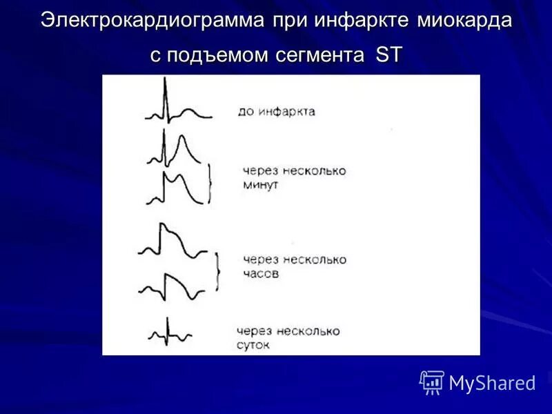 Экг подъем. Инфаркт миокарда ЭКГ сегмент St. Сегмент St при инфаркте миокарда. ЭКГ при инфаркте с подъемом St. Инфаркт миокарда с подъемом сегмента St ЭКГ.