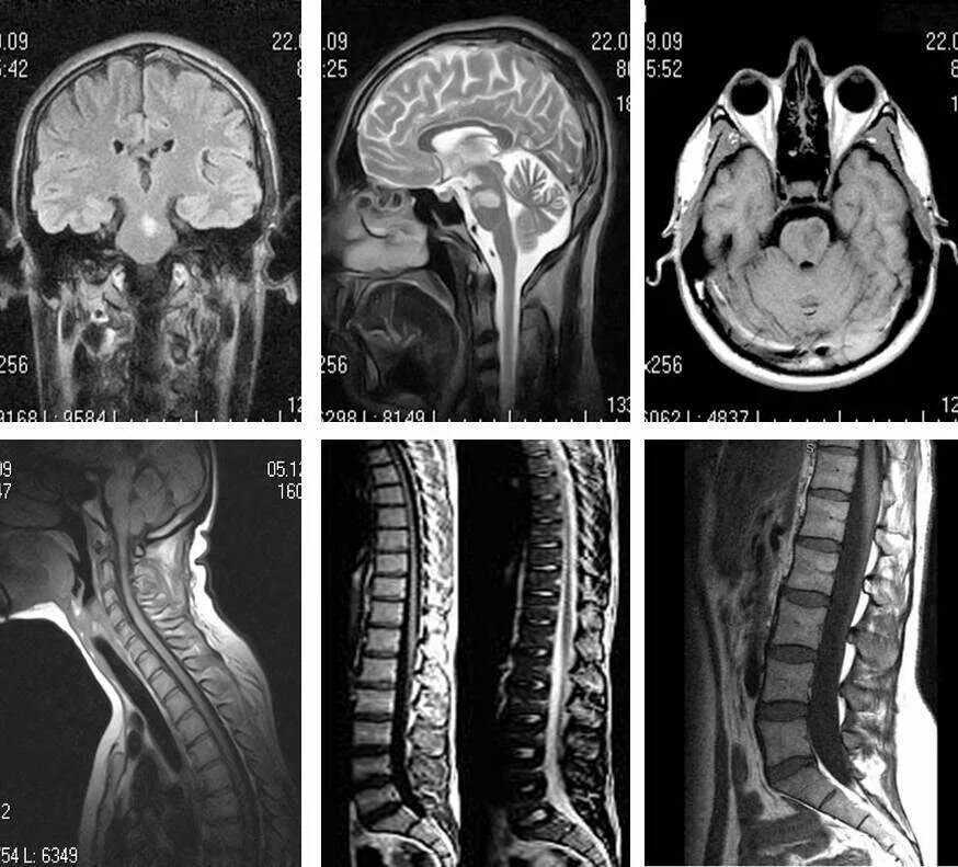 мрт шеи заключение. мрт ничего не показал. заключение мрт головного мозга описание.