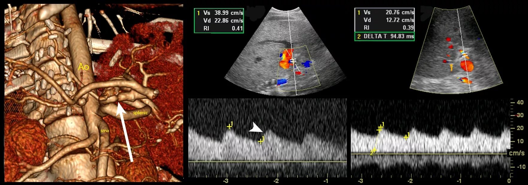 Ультразвуковая допплерография печеночных и портальных вен. Допплерография сосудов печени. УЗИ допплерография сосудов печени. Аневризма селезеночной артерии на УЗИ. Тромбоз почечной артерии