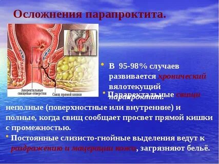 Парапроктит у мужчин лечение