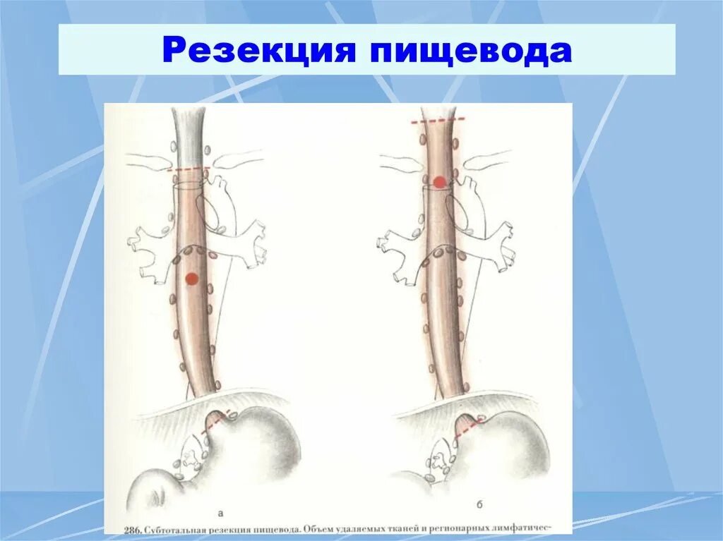  Операция Льюиса -экстирпация пищевода. Трансторакальная резекция пищевода. Резекция пищевода операции.