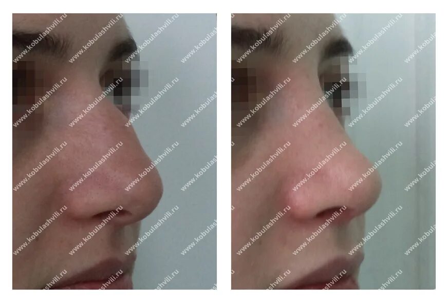 Ринопластика носа. Ринопластика махачкала хирурги. Ринопластика махачкала хирурги. Ринопластика в махачкале. Осман исаевич ринопластика.